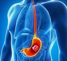 Gastrointestinal Cancer Treatment