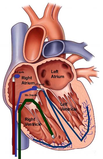 EP Catheter Ablation Market