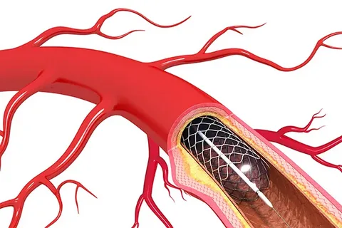 Atherectomy Devices Market