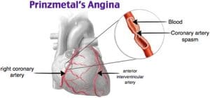 Prinzmetal Angina Therapeutics Market