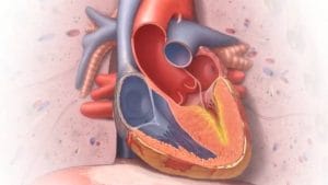 Restrictive Cardiomyopathy Treatment Market