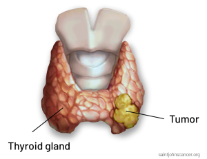 Thyroid Cancer Diagnostics Market