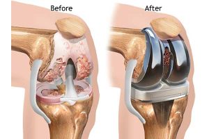 Knee Replacement Device Market