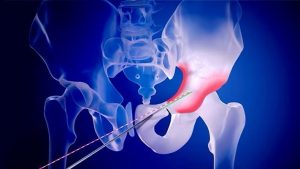 Interventional Oncology Market