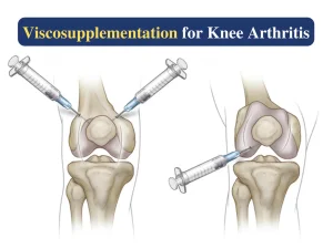 Viscosupplementation Market