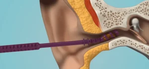 Earwax Removal Market