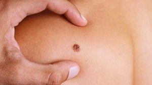 Metastatic Melanoma Cancer Diagnostics Market