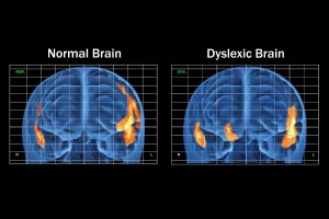 Dyslexia Treatments Market