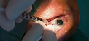 Anti-Vascular Endothelial Growth Factor Market