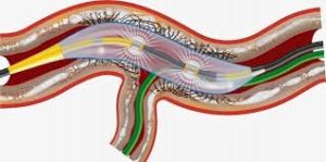 Intravascular Lithotripsy (IVL) Market