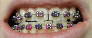 Orthodontic Braces Market
