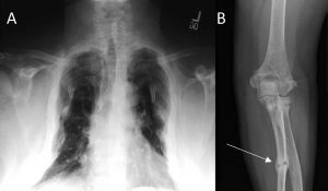 Tumour-Induced Osteomalacia Market