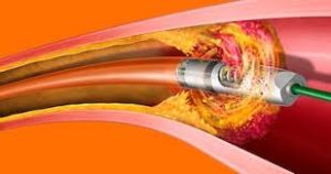 Atherectomy and Thrombectomy Devices Market