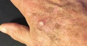 Actinic Keratosis Treatment Market