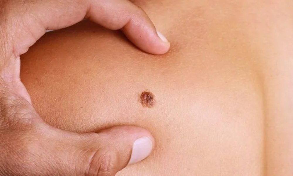 Metastatic Melanoma Cancer Diagnostics Market