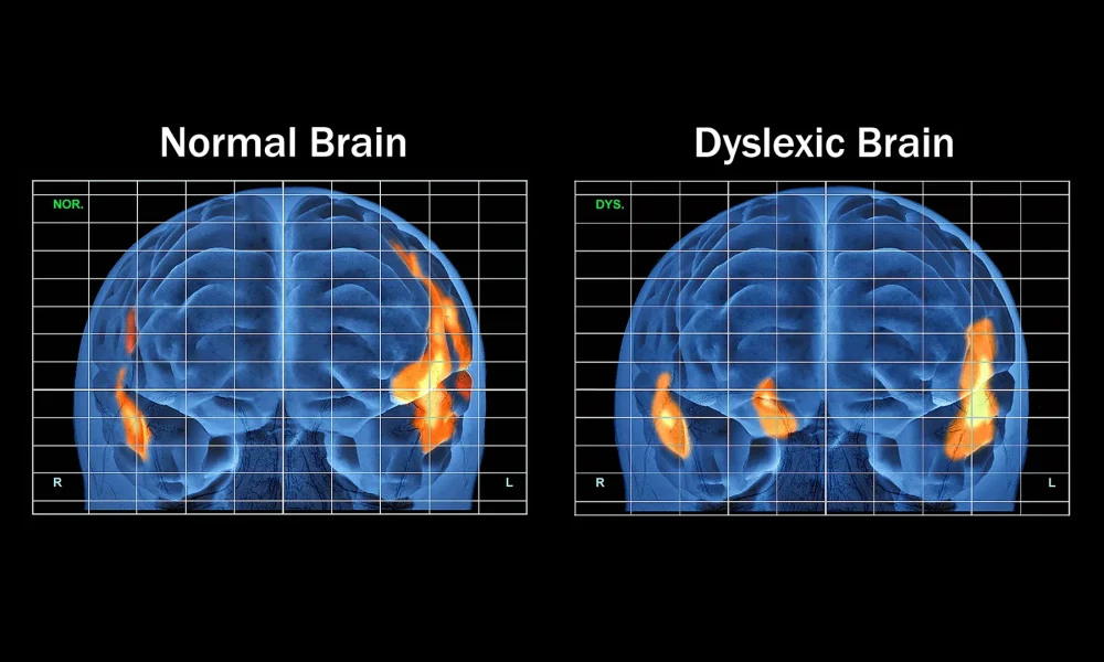 Dyslexia Treatments Market