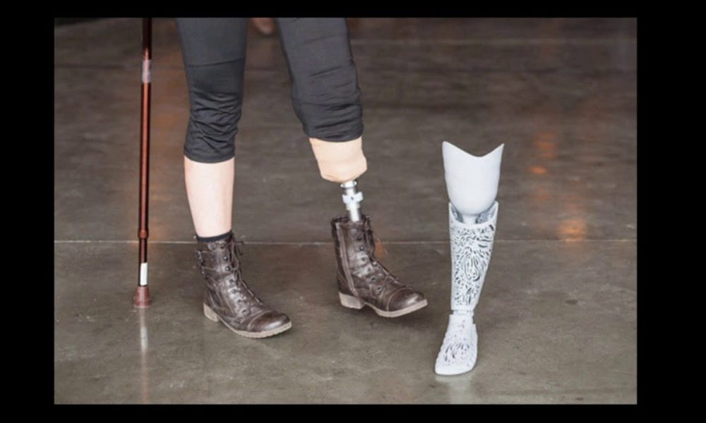 3D Printed Prosthetics Market