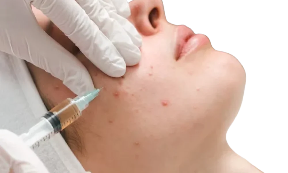 Acne Treatment Market