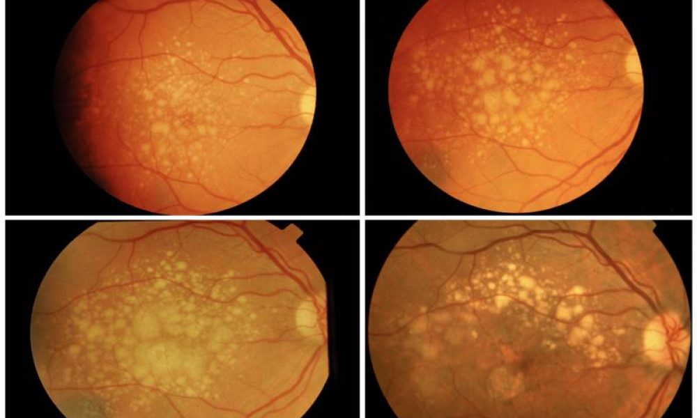 Age-related Macular Degeneration Market