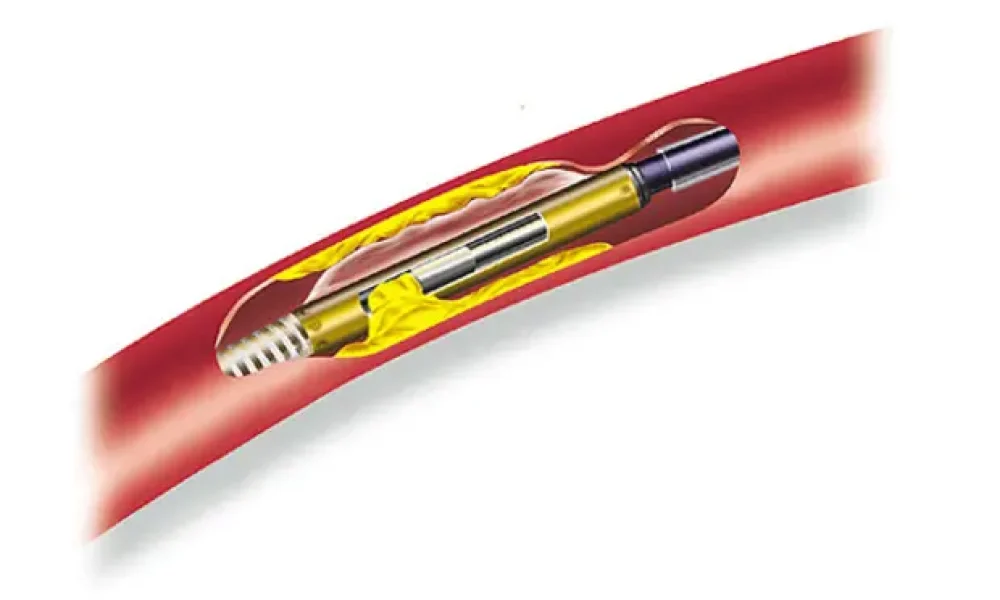 Atherectomy Device