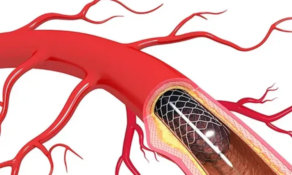 Atherectomy Devices Market