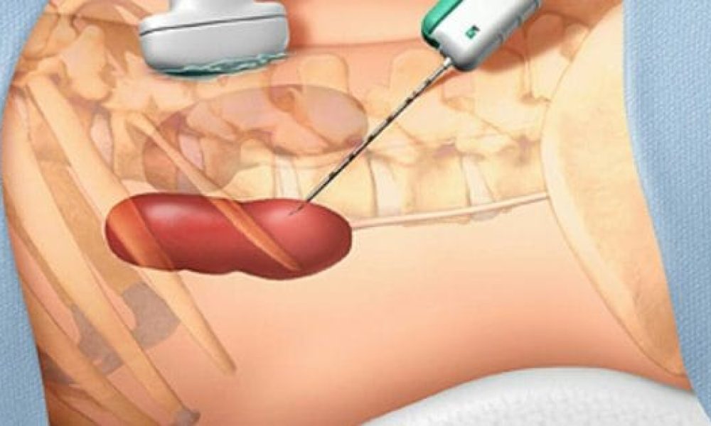 Biopsy Guidance System Market