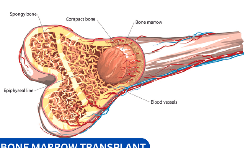 Bone Marrow Transplant Market report
