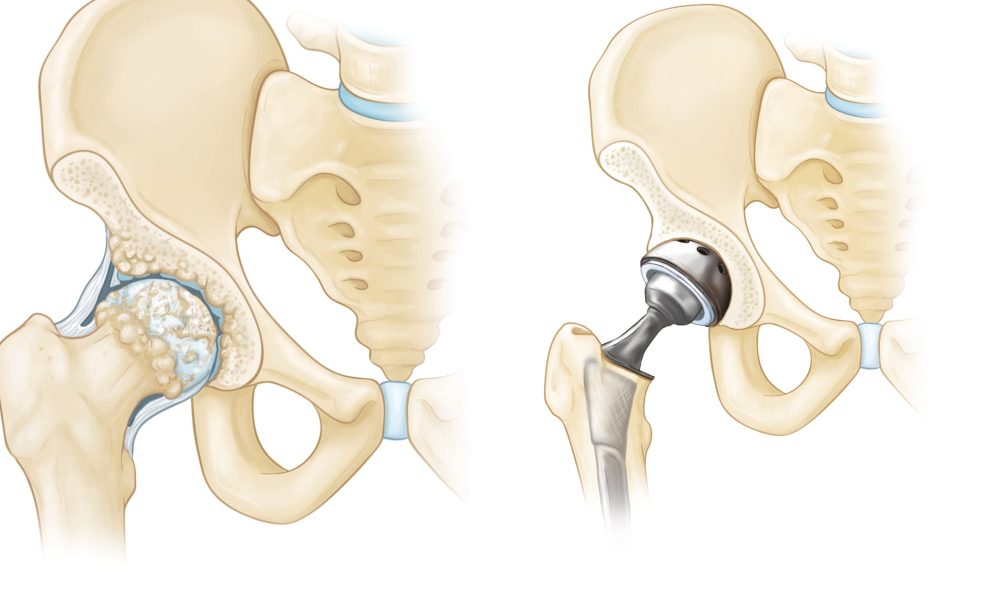 Bone Replacement