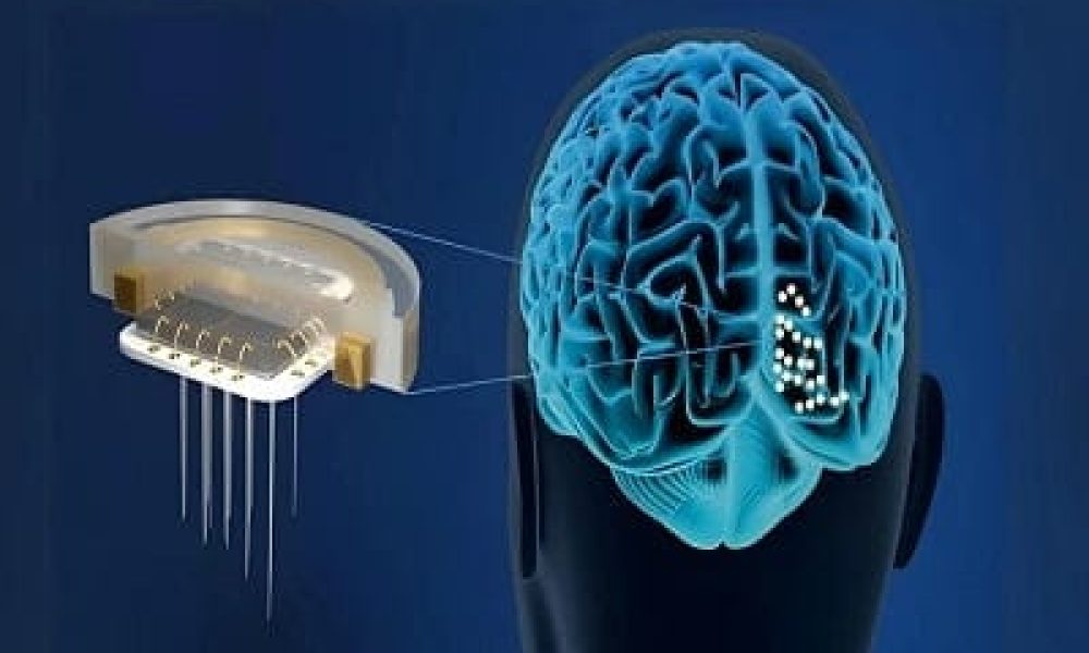 Brain Implants Market