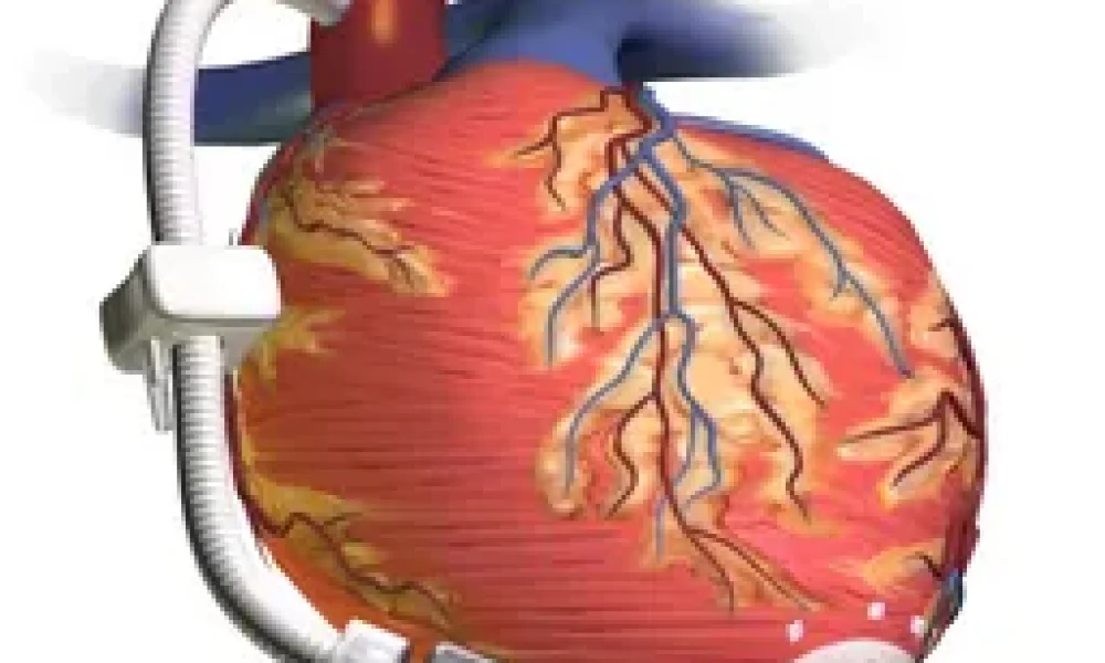 Cardiac Assist Devices Market