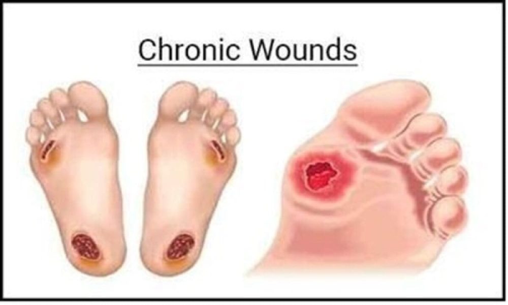 Chronic Wound Management Market