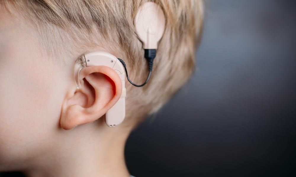 Cochlear Implants