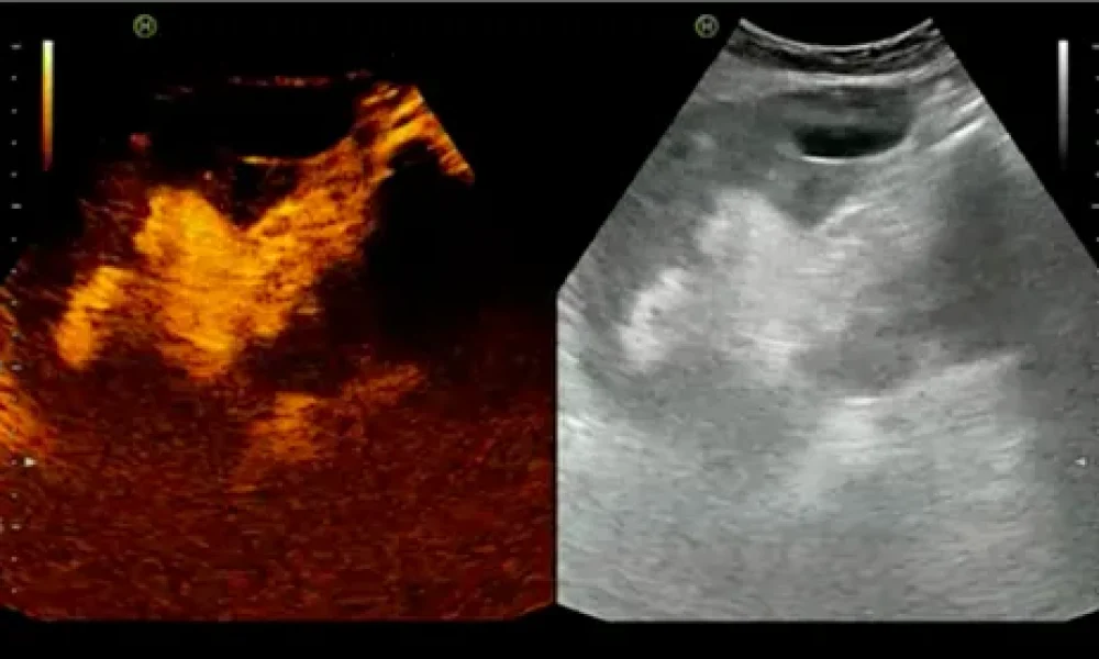 Contrast Enhanced Ultrasound