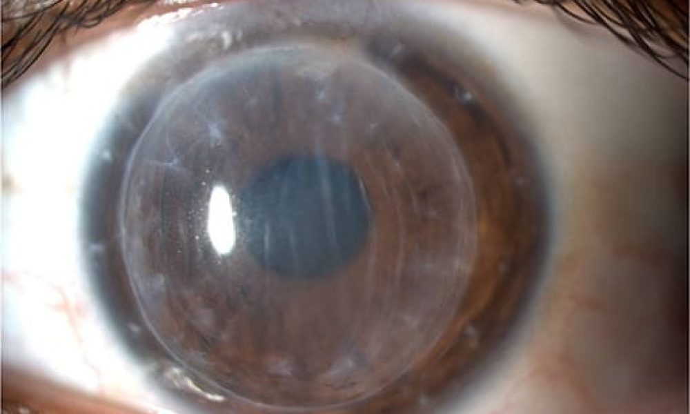 Corneal Graft Rejection Drug Market