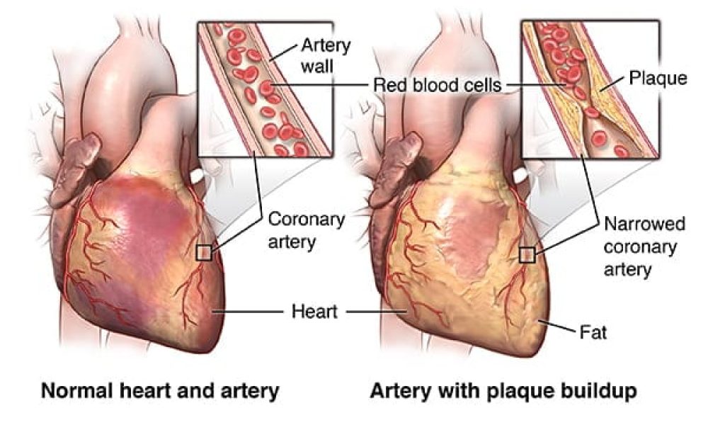 Coronary Artery Bypass Grafts Market