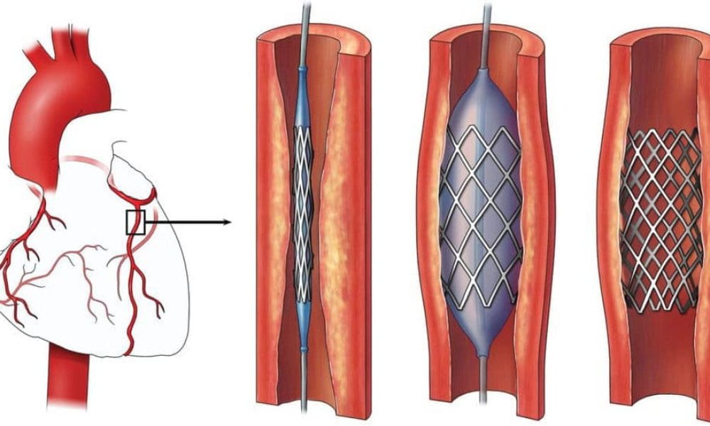 Coronary Stents Market