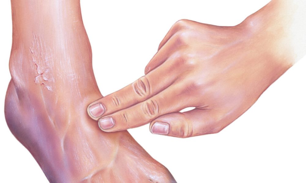 Critical Limb Ischemia Treatment Market