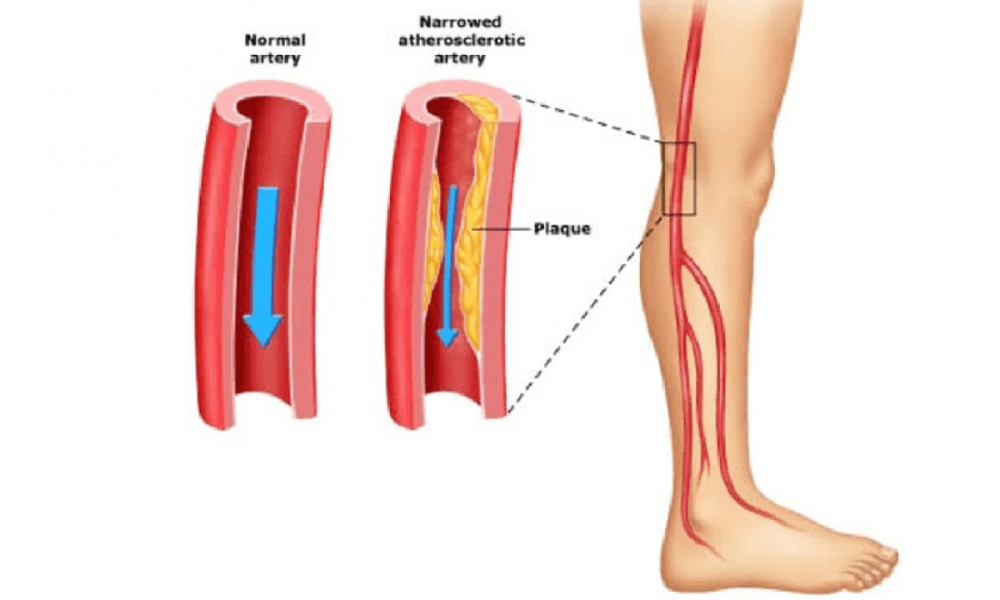 Critical Limb Ischemia Treatment Market