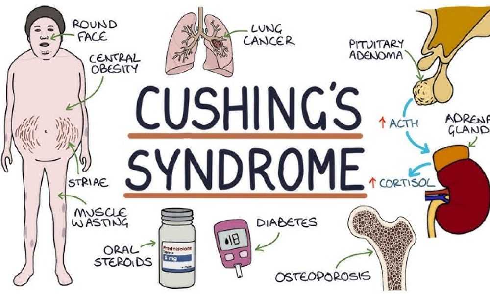 Cushing Syndrome Market