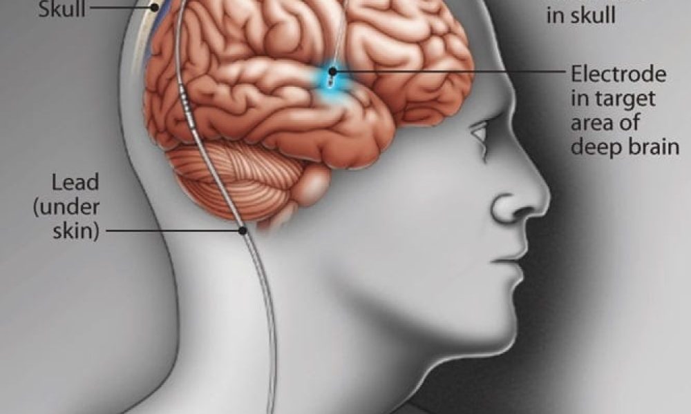 Deep Brain Stimulation Market