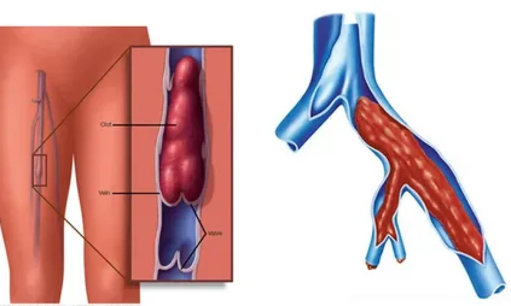 Deep Vein Thrombosis (DVT) Treatment