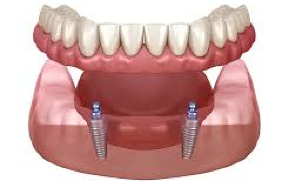 Dentures