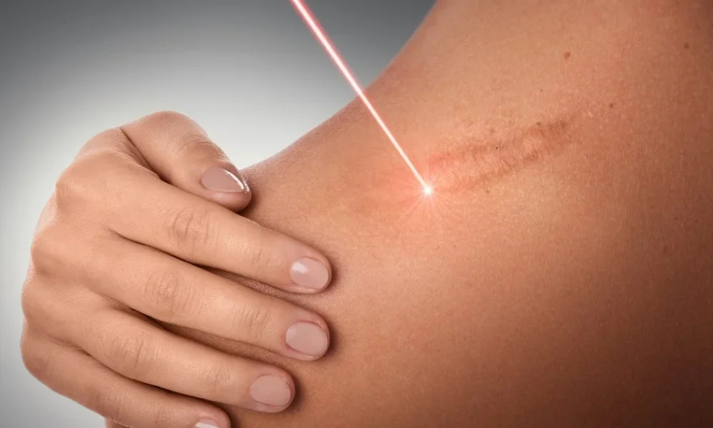 Dermatology Laser