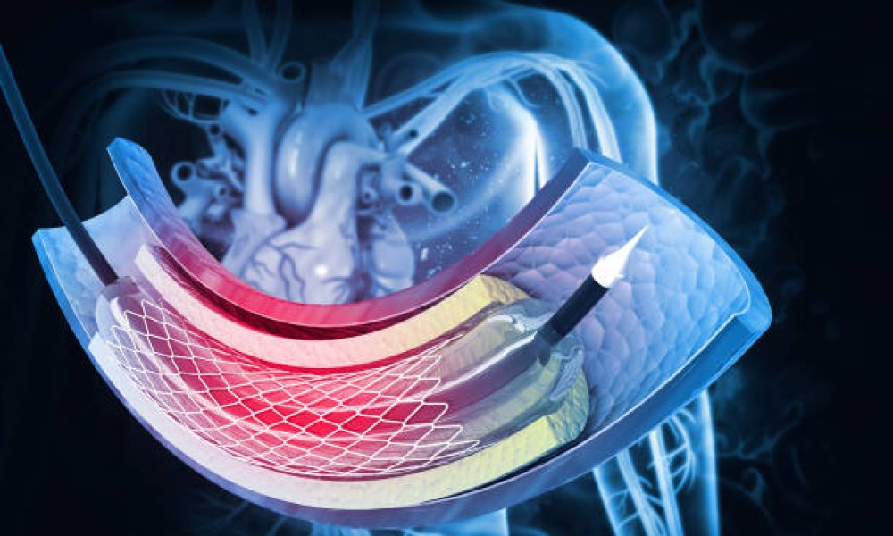 balloon angioplasty procedure with stent in vein.3d illustration
