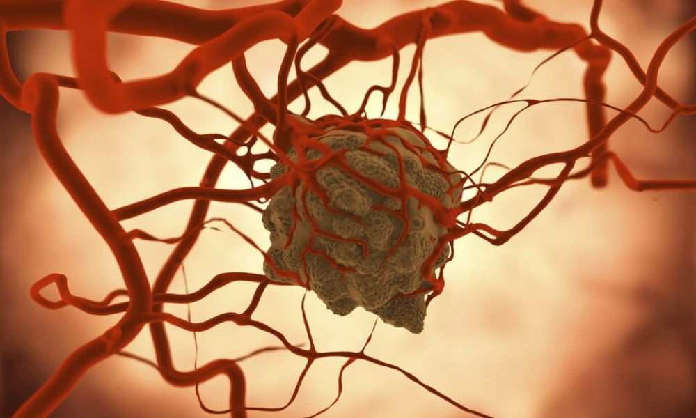Embolotherapy Market