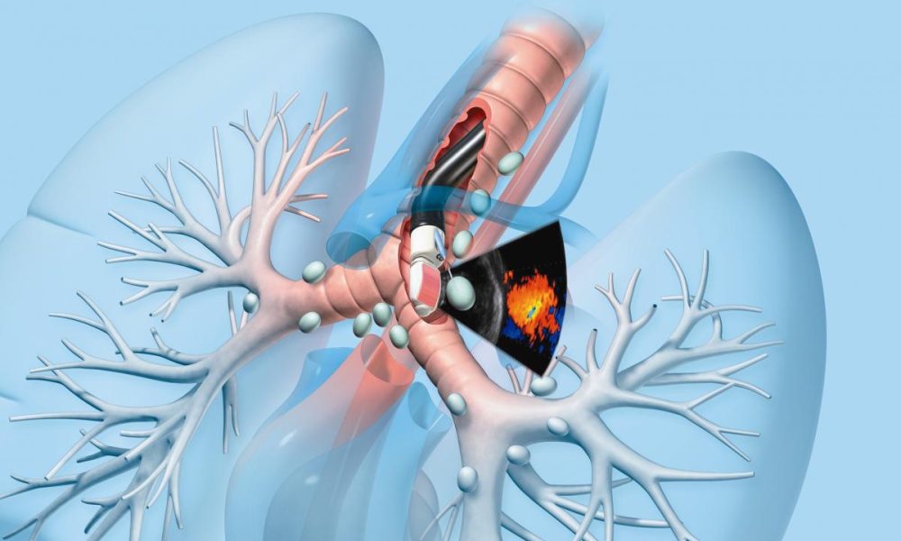 Endobronchial Ultrasound Biopsy Market