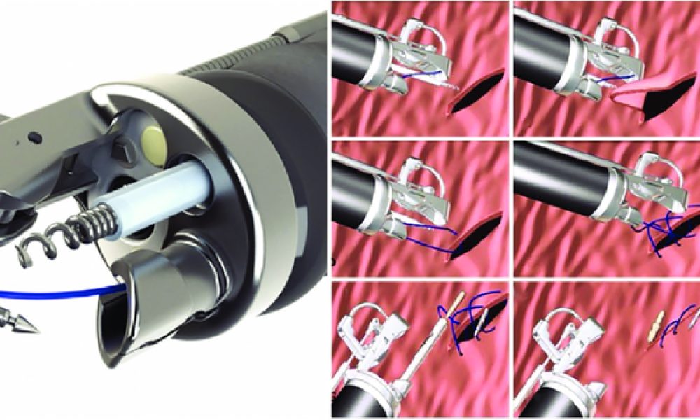 Endoluminal Suturing Devices Market Poised for Surge as Demand for ...