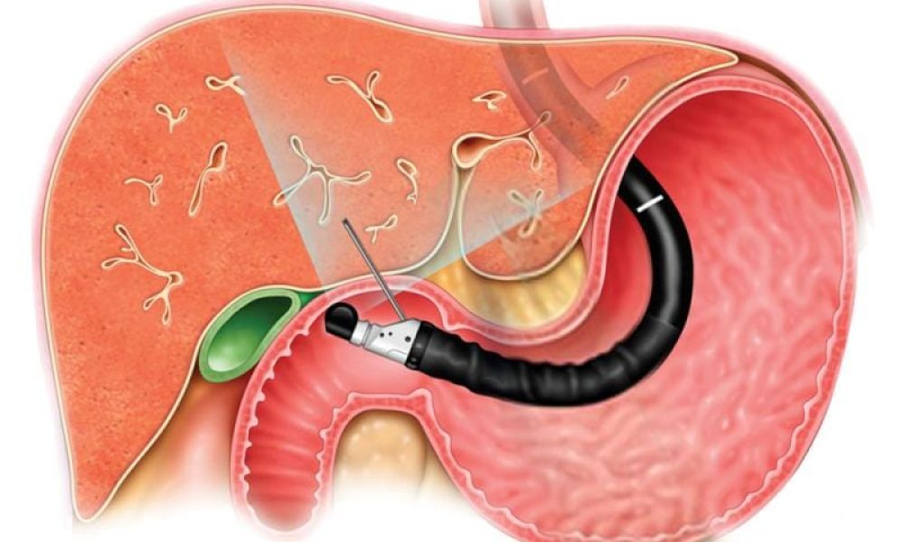 Endoscopy Ultrasound Market
