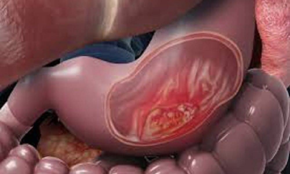Gastrointestinal Cancer Treatment