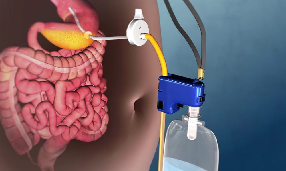 Gastrointestinal Medical Device